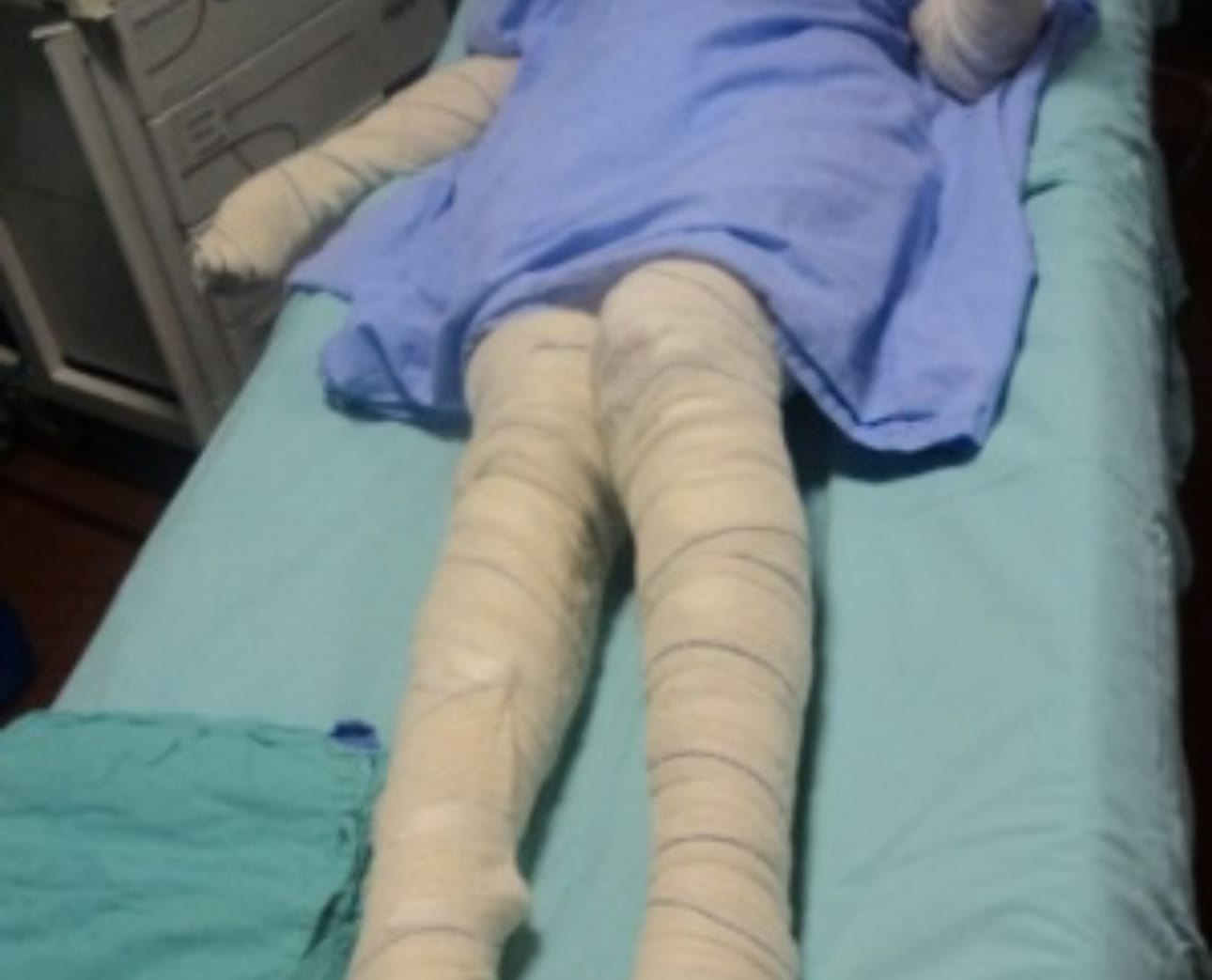 Mulher é queimada viva pelo companheiro e luta pela vida em hospital